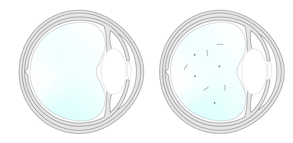 飛蚊症水晶體示意圖