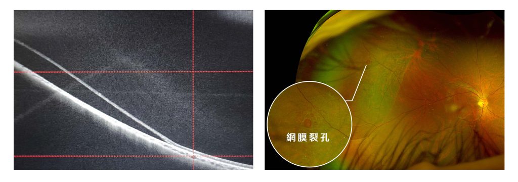 視網膜剝離與裂孔